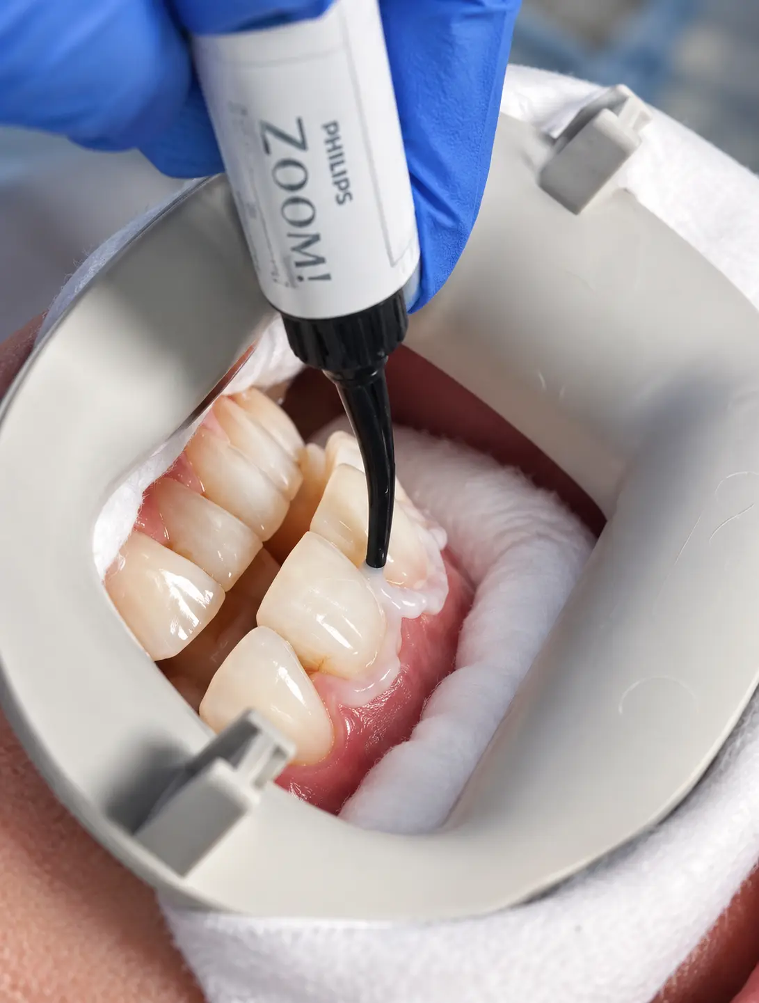 Philips Zoom whitening gel being applied with gums protected