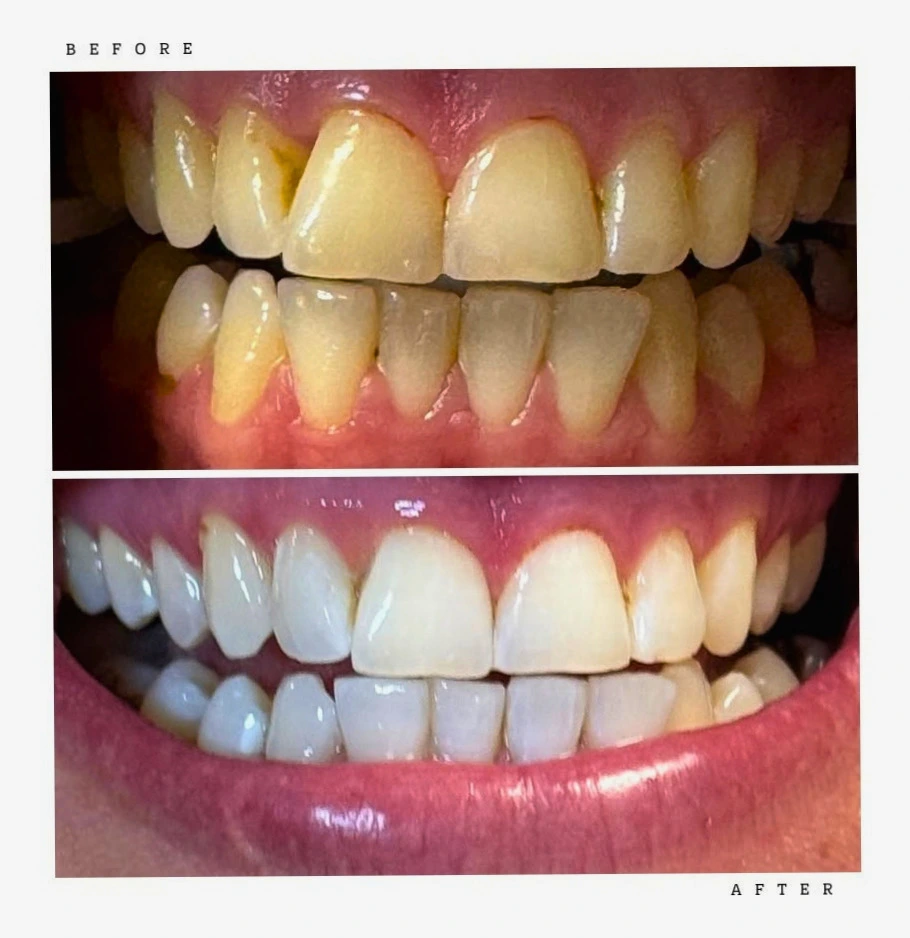 Transformation 1 Before & After: teeth before and after professional whitening