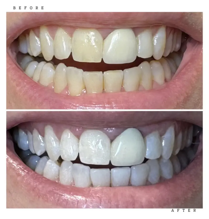 Transformation 2 Before & After: teeth before and after professional whitening