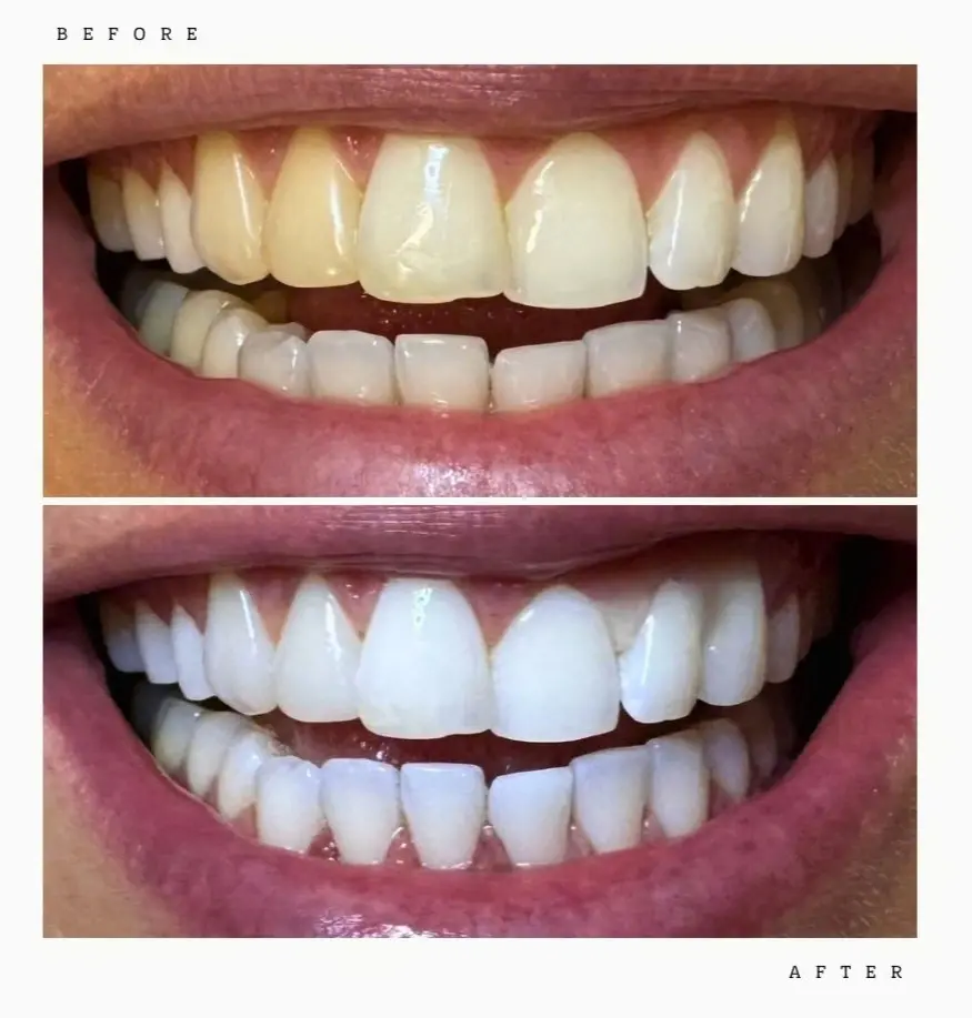 Transformation 3 Before & After: teeth before and after professional whitening