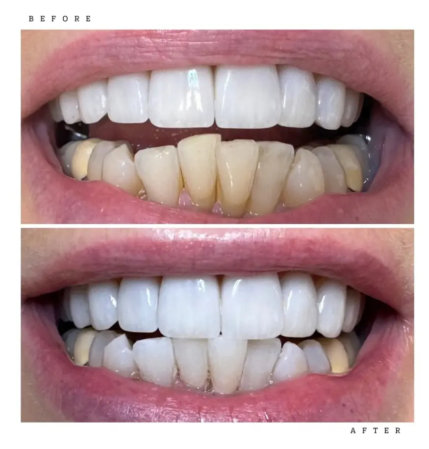 Transformation 4 Before & After: teeth before and after professional whitening
