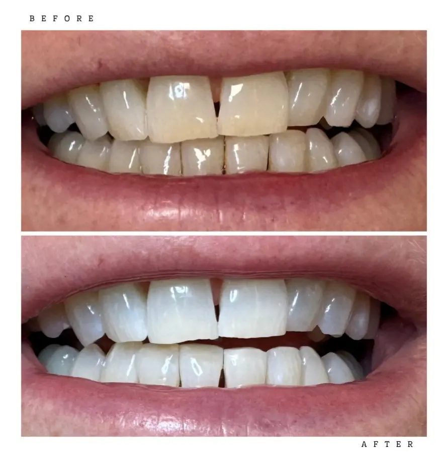 Transformation 5 Before & After: teeth before and after professional whitening