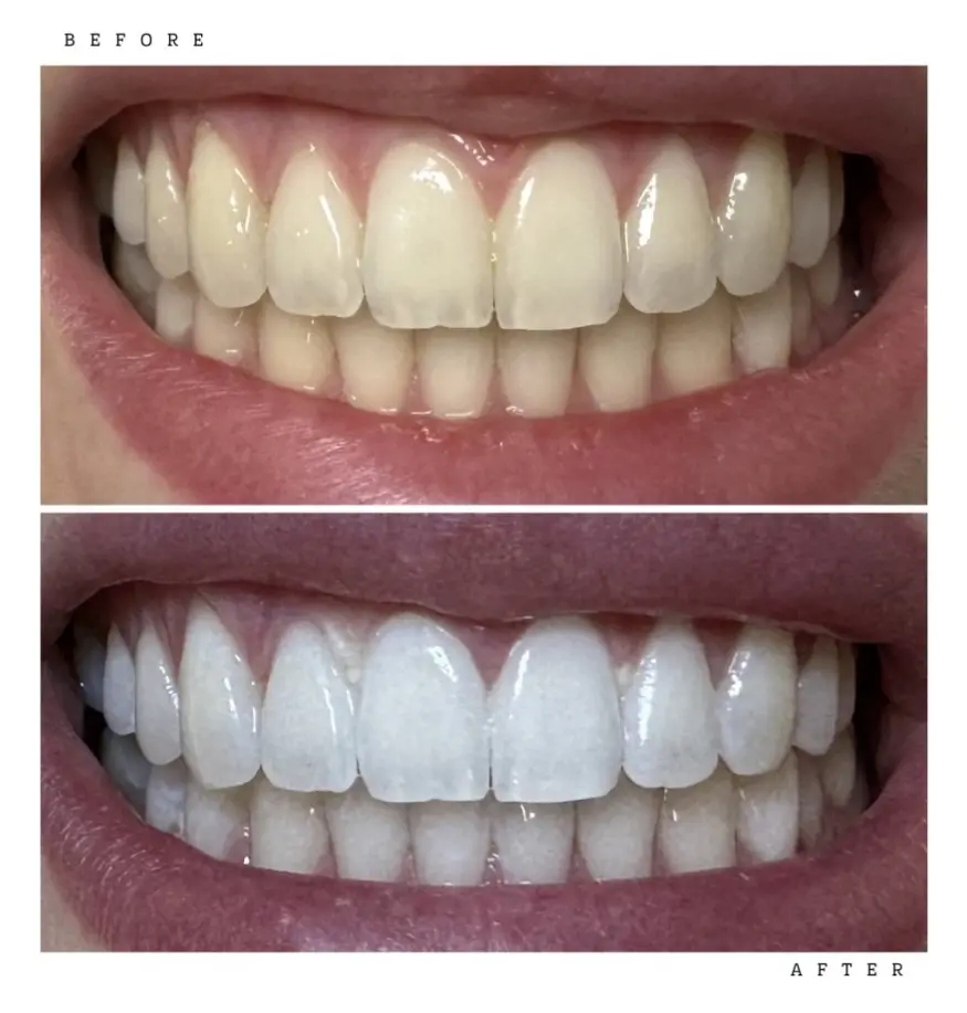 Transformation 6 Before & After: teeth before and after professional whitening
