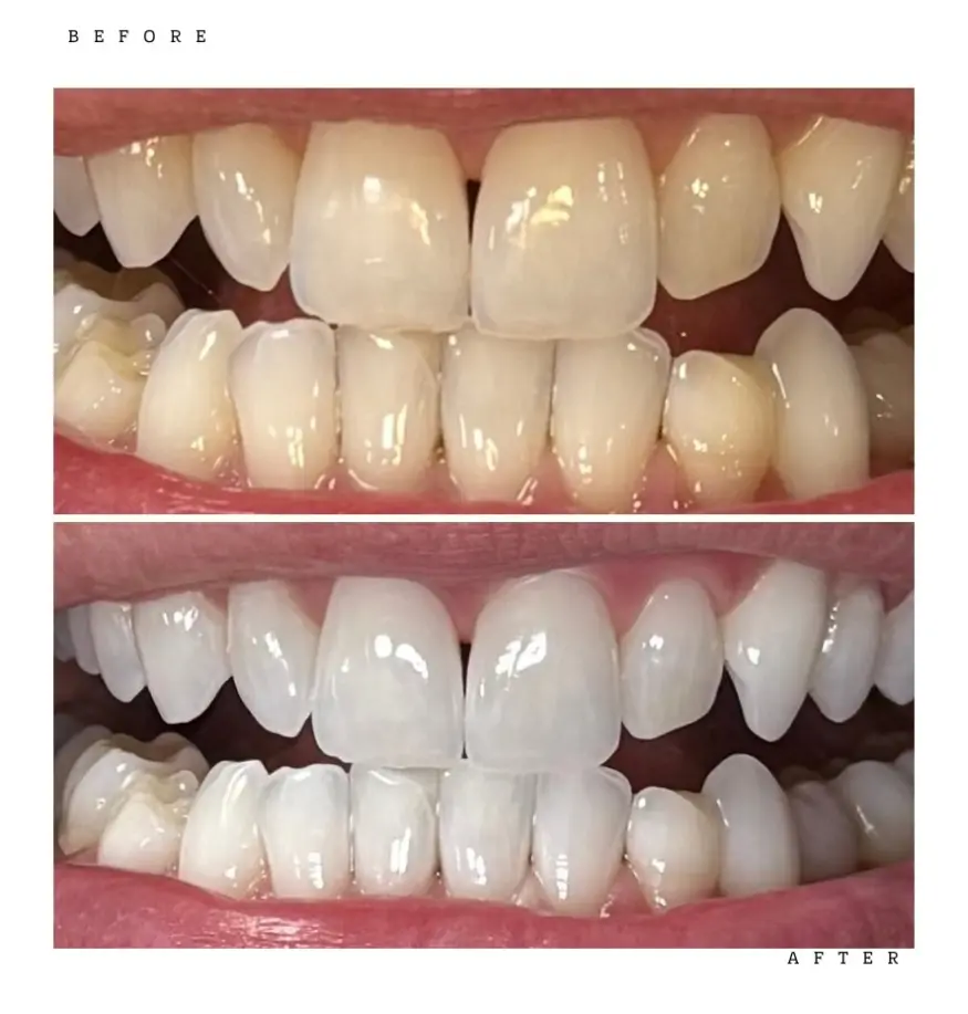 Transformation 7 Before & After: teeth before and after professional whitening