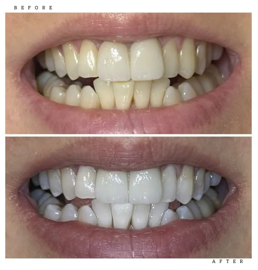 Transformation 8 Before & After: teeth before and after professional whitening
